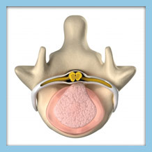 what is a bulging disc orthopedic laser spine surgery