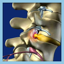 Foraminal Stenosis