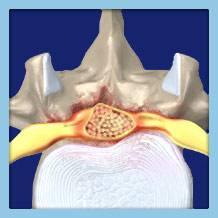 Spinal Bone Spurs