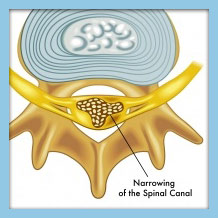 Spinal Bone Spurs