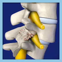 Spondylolisthesis