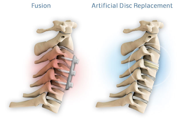 Fusion vs. ADR