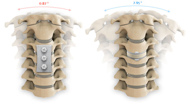 Fusion vs. ADR and range of motion