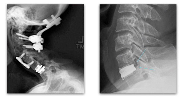 bulky fusion hardware vs. artificial disc implant