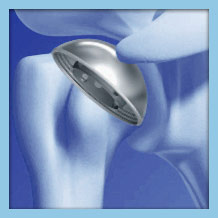 Resurfacing Shoulder Replacement Treatment