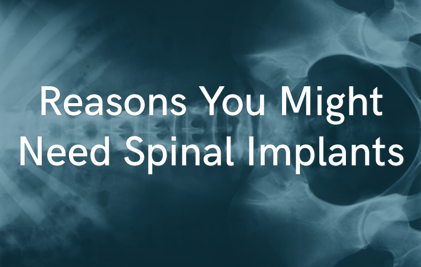 What are Spinal Implants?