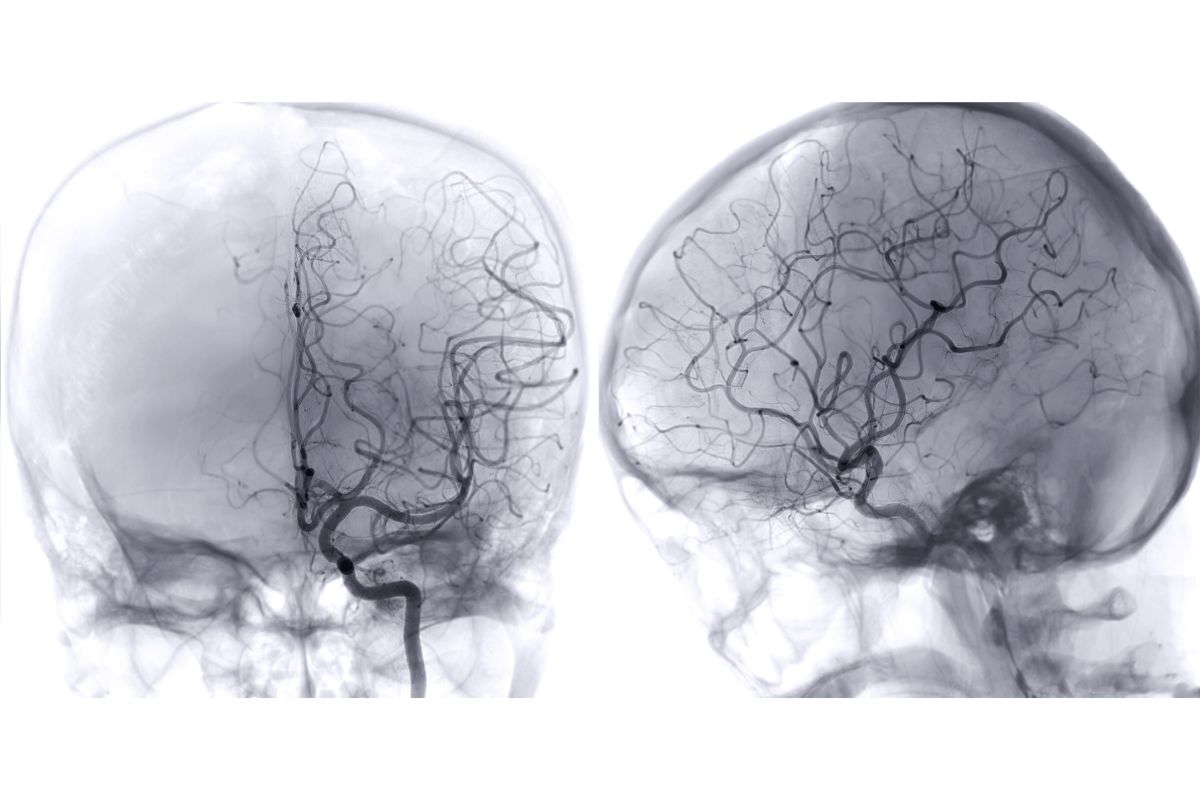 Cerebrovascular