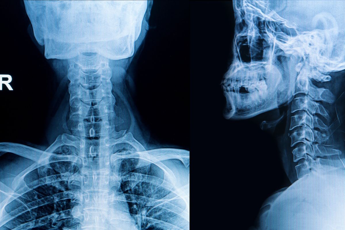 Cervical Spine