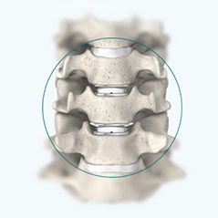 What is Cervical Artificial Disc Replacement