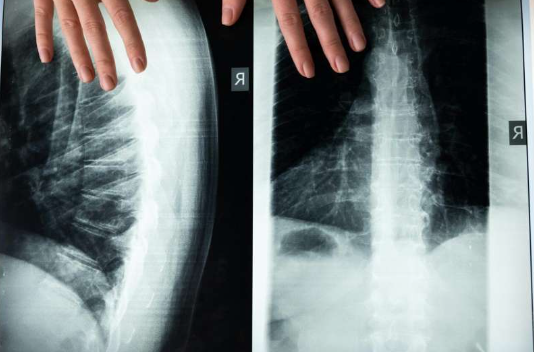 Pressure Sores Post-Spinal Injury