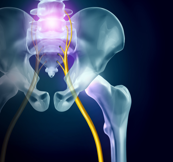 What's the Difference Between Back Pain and Sciatica? - PT