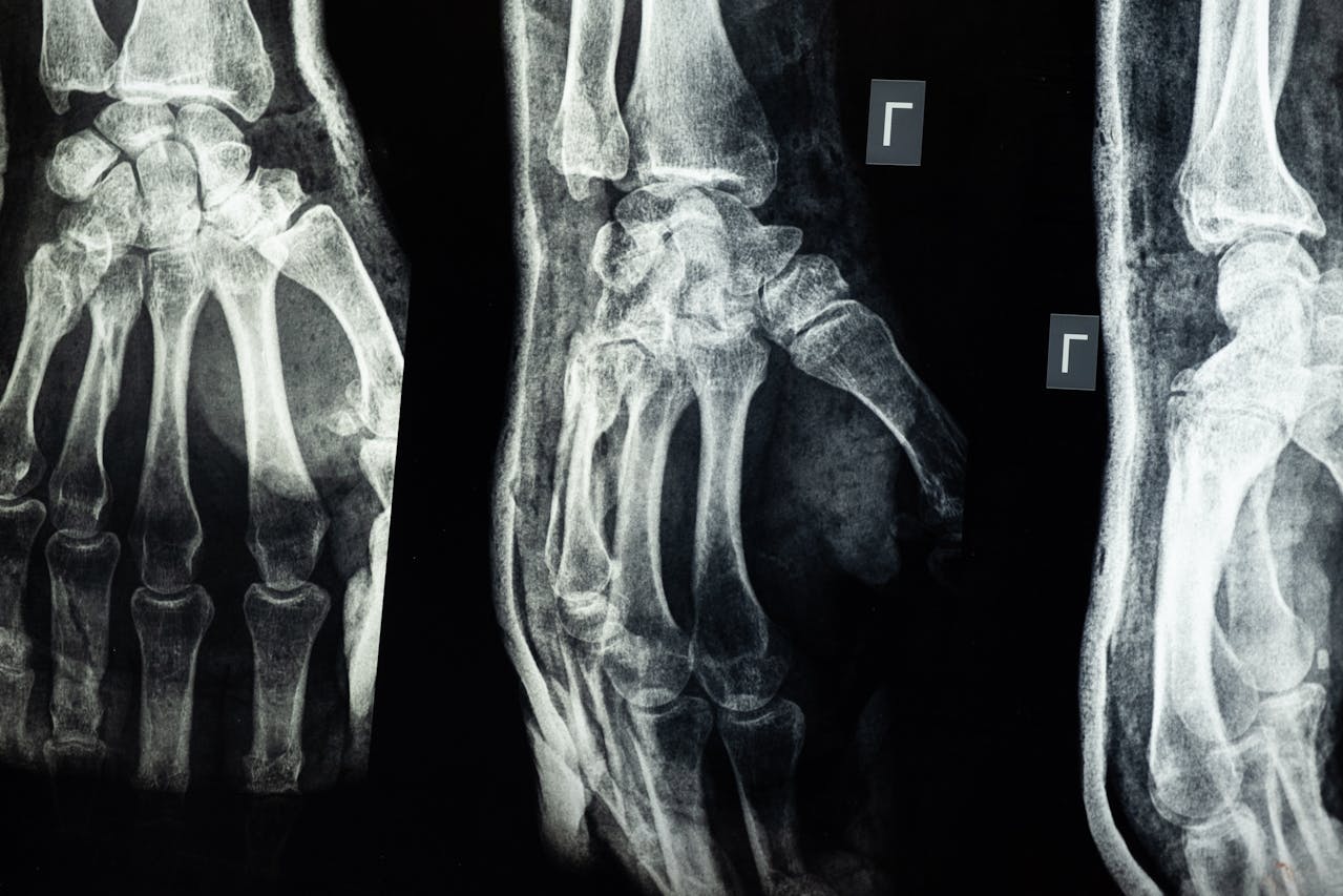 Spinal Fracture Patterns