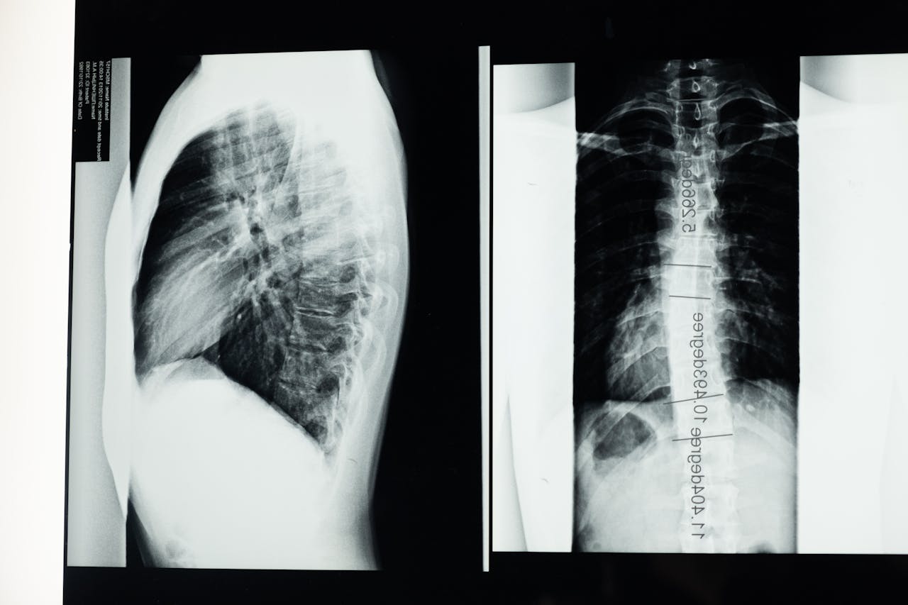Thoracolumbar Spine