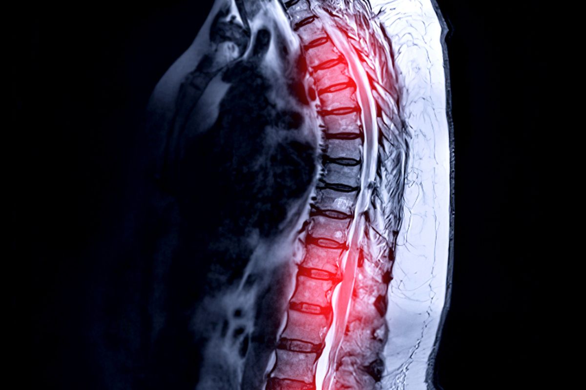 Traumatic spinal injury