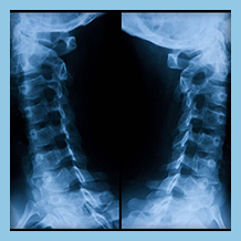 Anterior Cervical Discectomy Surgery