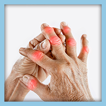 elderly hands showing symptoms of arthritis, including joint swelling, stiffness, and pain
