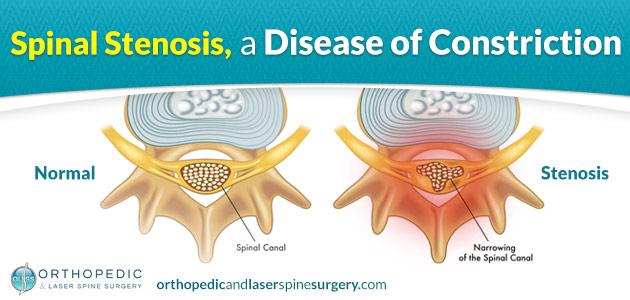 Spinal Stenosis - Sarasota Spine Specialists