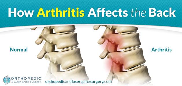 How Does Arthritis Affect the Back