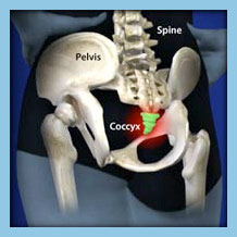 Coccydynia Diagnosis & Treatments