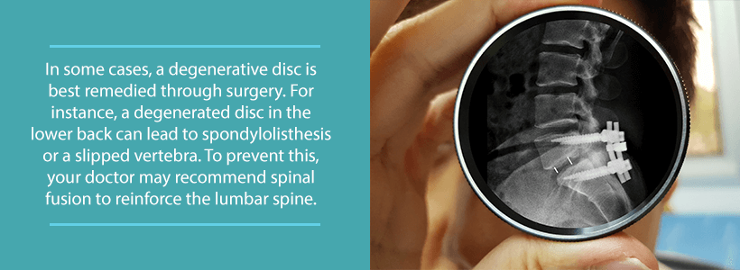 spinal fusion to repair degenerative disc disease