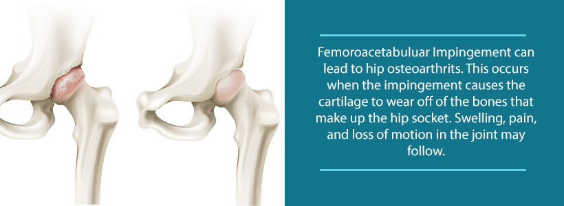 hip osteoarthritis from femoroacetabular impingement