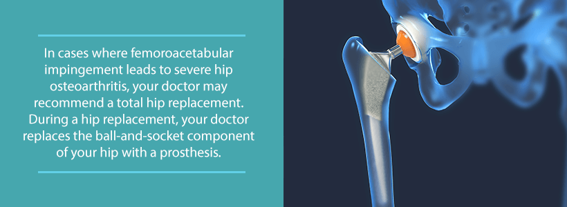 hip replacement for femoroacetabular impingement