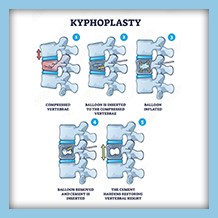 Kyphoplasty Surgery