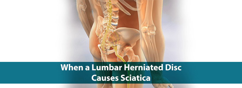 lumbar herniated disc with sciatica