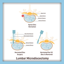 Lumbar Microdiscectomy Surgery