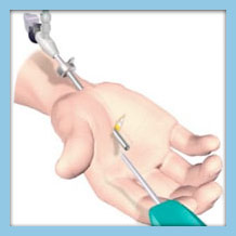 surgical tools being used to perform a precise operation on a patient's hand