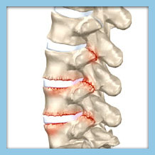 Image illustrating radiculitis in the spine, showing nerve root inflammation and associated pain