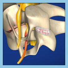 showing nerve root compression and associated pain in the spine.