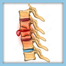 Illustration of spinal compression fractures, highlighting the collapse and damage of vertebrae with visible inflammation and injury to the spinal column.