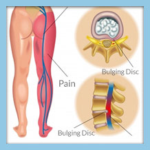 Sciatica Treatment - Find Relief Through Chiropractic Care in Littleton