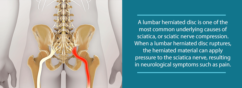 When a Lumbar Herniated Disc Causes Sciatica